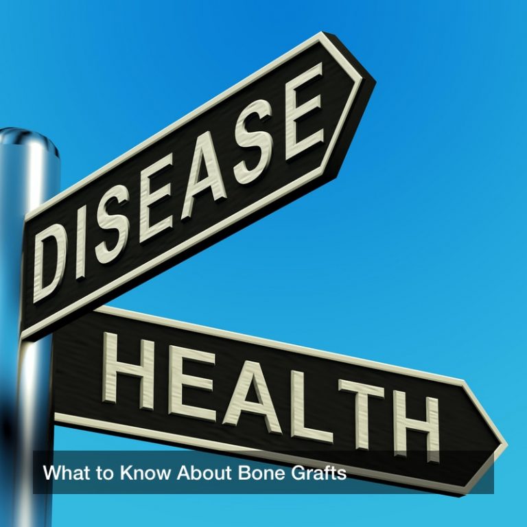 What to Know About Bone Grafts